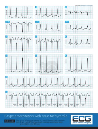 Photo for When patients with overt preexcitation experience sinus tachycardia, they also exhibit wide QRS wave tachycardia, which is a relatively easy to diagnose condition. - Royalty Free Image