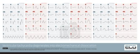 Photo for From the onset of paroxysmal ventricular tachycardia, the patient's QRS wave gradually prolongs, and their heart rate gradually slows down until death  from VT to electromechanical dissociation). - Royalty Free Image
