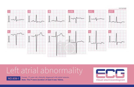 Photo for The electrocardiogram characteristics of left atrial abnormality are P wave duration greater than 120ms, P wave notch, peak to peak interval greater than or equal to 40ms, and increased PtfV1. - Royalty Free Image