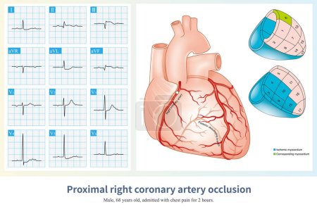 Téléchargez les photos : Lorsque l'infarctus aigu du myocarde inférieur est causé par l'occlusion de l'artère coronaire droite, l'amplitude de l'élévation du segment ST dans le plomb III dépasse généralement celle du plomb II. - en image libre de droit