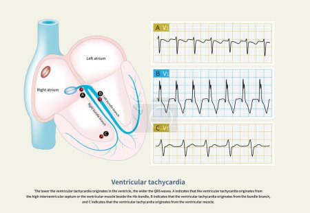Foto de Cabe señalar que la taquicardia ventricular originada en diferentes partes del ventrículo tiene diferentes anchuras de onda QRS, lo que ayuda a inferir el lugar de origen de la taquicardia ventricular.. - Imagen libre de derechos