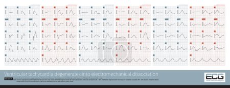 Photo for From the onset of paroxysmal ventricular tachycardia, the patient's QRS wave gradually prolongs, and their heart rate gradually slows down until death  from VT to electromechanical dissociation. - Royalty Free Image