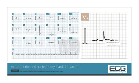Photo for Distal occlusion of the right coronary artery can cause inferior and posterior myocardial infarction.When the posterior myocardial infarction occurs, the ST segment of V7-V9 leads is elevated. - Royalty Free Image
