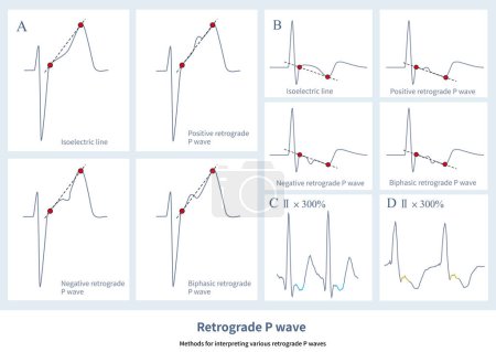 Foto de En el ECG, la onda P retrógrada puede ser una onda positiva, una onda negativa, una onda bifásica o una onda de línea equipotencial, que está relacionada con el orden de despolarización auricular retrógrada.. - Imagen libre de derechos