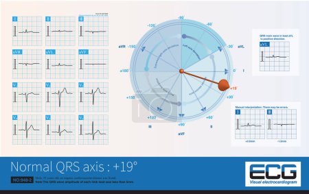 Téléchargez les photos : When the frontal axis is -3 , the maximum QRS depolarization potential is closest to the axis of lead , so the R-wave amplitude of lead  is the highest. - en image libre de droit