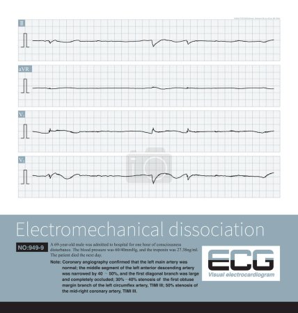 Téléchargez les photos : Electromechanical separation is a kind of terminal ECG. The patient's ECG has electrical signals, the ECG wave is widened with morphological abnormalities, and the ventricle has no contraction. - en image libre de droit