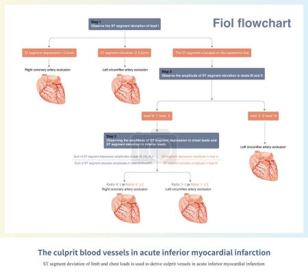 Téléchargez les photos : En cas d'infarctus aigu du myocarde inférieur, le décalage du segment ST de l'électrocardiogramme peut être utilisé pour dériver le vaisseau responsable, communément appelé processus Fiol.. - en image libre de droit
