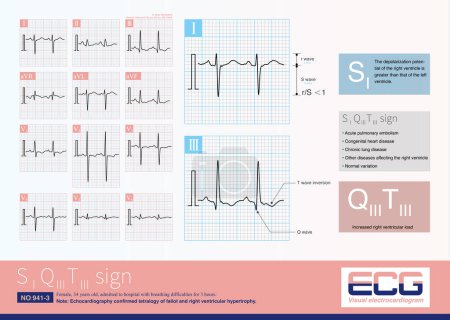 Photo for SQT sign is an electrocardiogram change of right heart disease, which is not only seen in acute pulmonary embolism, but also in other diseases affecting the right heart. - Royalty Free Image