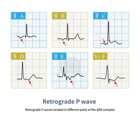 Foto de En el electrocardiograma, la onda P retrógrada se puede ubicar antes, dentro o después de la onda QRS, dependiendo de la diferencia de velocidad entre la transmisión hacia adelante y hacia atrás.. - Imagen libre de derechos