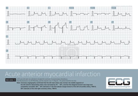 Photo for A 69 year old patient with acute myocardial infarction, whose infarction affected the anterior wall, high lateral wall, and inferior wall, ultimately died during hospitalization. - Royalty Free Image