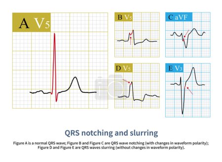 Téléchargez les photos : La dépolarisation ventriculaire normale produit des ondes QRS lisses et nettes ; lorsque la dépolarisation du muscle ventriculaire local est altérée, des entailles et des bouffées QRS sont produites.. - en image libre de droit