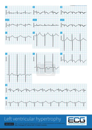 Photo for The typical ECG for left ventricular hypertrophy is left ventricular high voltage, sometimes with significant ST-T changes, U-wave changes, and QT interval prolongation. - Royalty Free Image