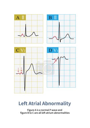 Photo for Changes such as left atrial enlargement, increased pressure in the left atrium, fibrosis or necrosis of the left atrial myocardium can lead to left atrial abnormalities on the ECG. - Royalty Free Image