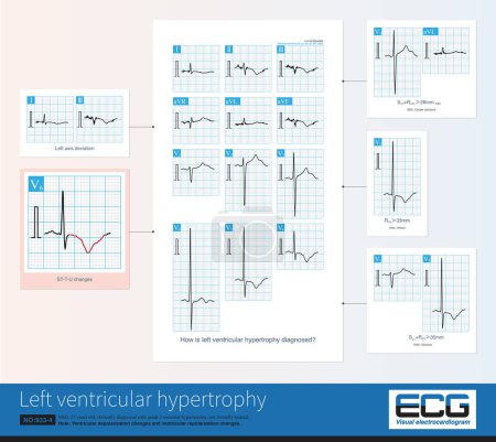 Photo for Common ECG changes in left ventricular hypertrophy include increased amplitude of QRS waves, ST-T changes, U-wave changes, left axis deviation, and left atrial abnormality. - Royalty Free Image