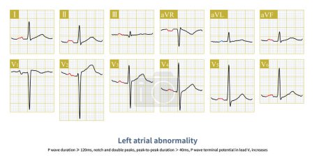 Photo for When left atrial lesions, including anatomical and electrical lesions, cause changes such as sinus P wave widening and notches on the ECG, it is called left atrial abnormality. - Royalty Free Image