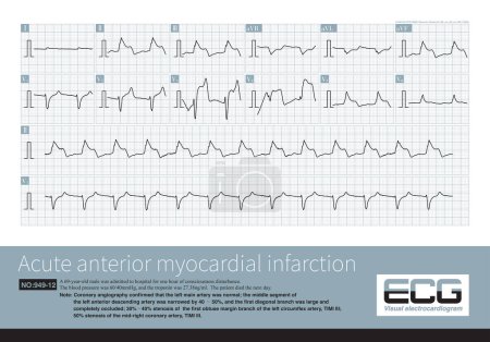 Photo for A 69 year old patient with acute myocardial infarction, whose infarction affected the anterior wall, high lateral wall, and inferior wall, ultimately died during hospitalization. - Royalty Free Image