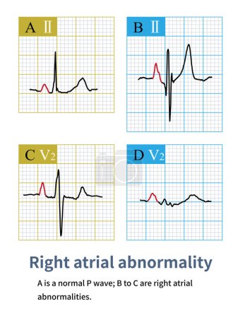 Photo for The electrocardiogram characteristic of right atrial abnormality is an increase in  P wave amplitude, with limb leads exceeding 2.5mm and chest leads exceeding 1.5mm. - Royalty Free Image