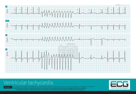 Photo for The depolarization time of the right atrium is prolonged, causing the co-depolarization time of the left and right atria to be prolonged, so the P wave amplitude increases. - Royalty Free Image