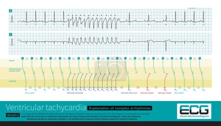 Photo for An 11 month old male infant was clinically diagnosed with viral myocarditis and experienced transient atrioventricular block after ventricular tachycardia, resulting in complex arrhythmias. - Royalty Free Image