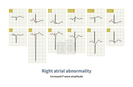 Photo for Male, 34 years old, clinically diagnosed with polycythemia vera. The electrocardiogram indicates atrial abnormality and right ventricular hypertrophy. - Royalty Free Image