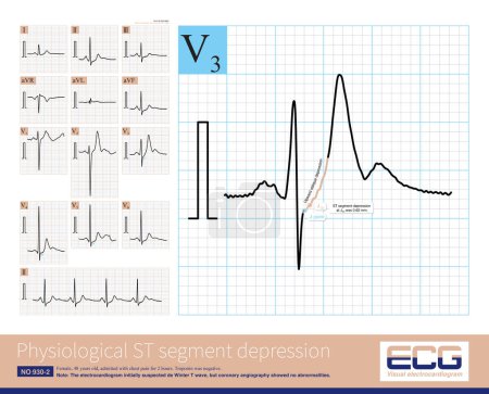 Photo for Sometimes, the ST segment of the electrocardiogram in young and middle-aged women shows an upward oblique depression, many of which belong to physiological ST segment depression. - Royalty Free Image