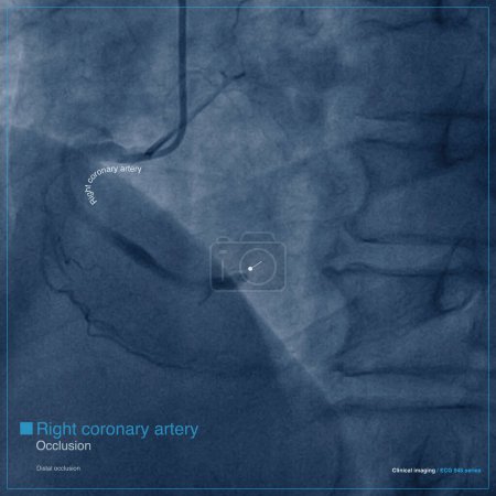 Photo for Male, 68 years old, chest pain for 7 hours. Coronary angiography suggests occlusion of the distal right coronary artery. See Series 945 for clinical ECG. - Royalty Free Image