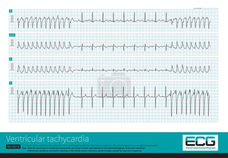 Photo for An 11 month old male infant was clinically diagnosed with cytomegalovirus myocarditis. The child experienced a brief atrioventricular block after a ventricular tachycardia attack. - Royalty Free Image