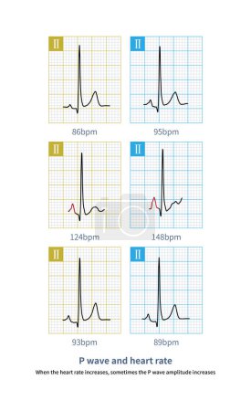 Téléchargez les photos : Lorsque la fréquence cardiaque augmente, parfois l'amplitude de l'onde P. C'est un phénomène physiologique, ne diagnostiquez pas l'anomalie auriculaire droite.. - en image libre de droit
