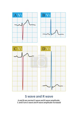 Photo for A and B are the normal S wave and R wave amplitude; C and D are the S wave and R wave of a case of left ventricular hypertrophy with a significant increase in amplitude. - Royalty Free Image