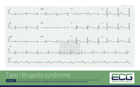 Photo for Female, 70 years old, clinically diagnosed with pulmonary bullae. Type I Brugada pattern appears in the right chest leads of the ECG, and ECG changes need to be followed. - Royalty Free Image