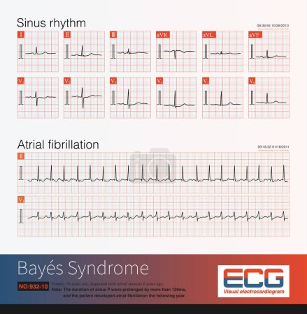 Photo for A pre elderly woman suffered from mitral stenosis. In 2010, her electrocardiogram showed sinus rhythm and left atrial abnormality, and in 2011, she progressed to atrial fibrillation. - Royalty Free Image