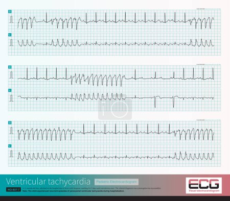 Photo for An 11 month old male infant was clinically diagnosed with cytomegalovirus myocarditis. The child repeatedly experienced ventricular tachycardia during hospitalization. - Royalty Free Image