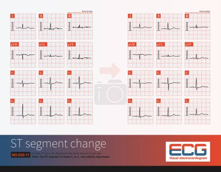 Photo for Female, 57 years old, diagnosed with mitral stenosis 6 years ago. Two outpatient electrocardiograms in 2010 showed left atrial abnormality and ST segment  changes. - Royalty Free Image