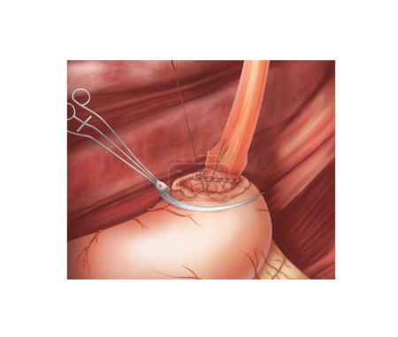 Foto de Cirugía de anastomosis gastroesofágica.Esta ilustración médica muestra la técnica de anastomosis del estómago y el esófago remanentes.. - Imagen libre de derechos