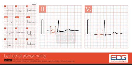 Photo for Female, 57 years old, diagnosed with mitral stenosis 6 years ago. When this ECG was taken, the patient still maintained sinus rhythm and developed atrial fibrillation the following year. - Royalty Free Image