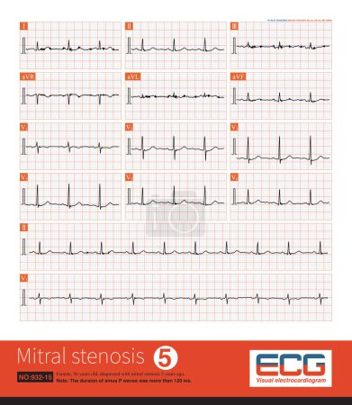 Photo for Female, 55 years old, diagnosed with mitral stenosis 5 years ago. When this ECG was taken, the patient still maintained sinus rhythm.Note that the P wave duration was widened. - Royalty Free Image