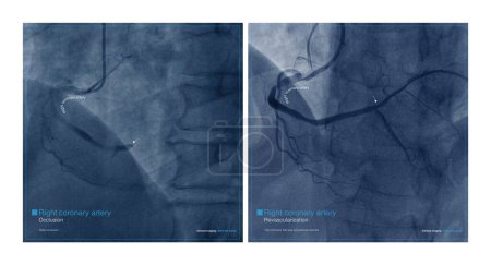 Photo for Male, 68 years old, chest pain for 7 hours. Coronary angiography suggests occlusion of the distal right coronary artery. The patient was successfully placed with a coronary stent. - Royalty Free Image