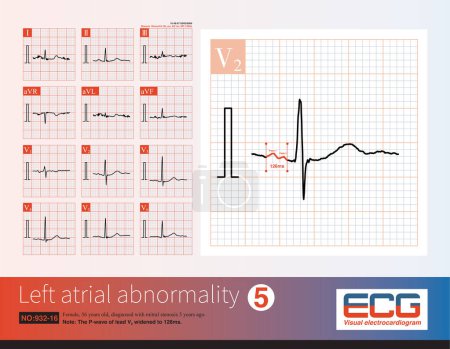 Photo for Female, 56 years old, diagnosed with mitral stenosis 5 years ago. When this ECG was taken, the patient still maintained sinus rhythm.Note that the P wave duration was widened. - Royalty Free Image
