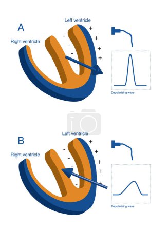 Téléchargez les photos : Lorsque tout le ventricule est dépolarisé et repolarisé, l'onde QRS et l'onde T générées dans la face de l'électrode exploratrice à la surface du corps sont de la même polarité. - en image libre de droit