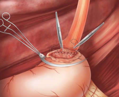 Foto de Cirugía de anastomosis gastroesofágica.Esta ilustración médica muestra la técnica de anastomosis del estómago remanente y el esófago.bosquejo. - Imagen libre de derechos