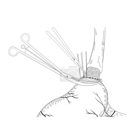 Téléchargez les photos : Chirurgie de l'anastomose gastro-œsophagienne Cette illustration médicale montre la technique de l'anastomose du reste de l'estomac et de l'œsophage.. - en image libre de droit