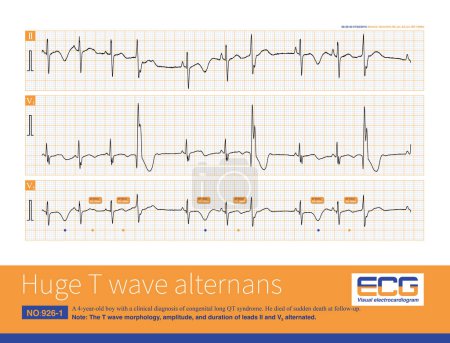 Photo for A 4-year-old boy with intermittent QT prolongation, huge T wave electrical alternation and frequent premature ventricular beats and ventricular tachycardia on Holter recording. - Royalty Free Image