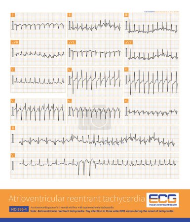 Photo for A 1-month-old child developed atrioventricular reentrant tachycardia. When tachycardia occurred,  retrograde P waves can be detected each QRS complex. - Royalty Free Image