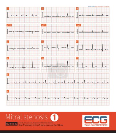 Photo for Female, 51 years old, diagnosed with mitral stenosis. When this ECG was taken, the patient still maintained sinus rhythm.Note that the P wave duration was widened. - Royalty Free Image