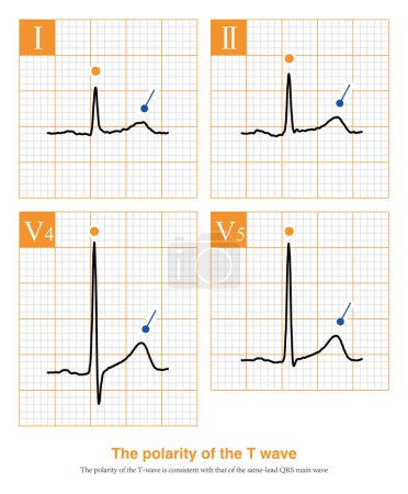 Photo for On the 12-lead ECG, under normal circumstances, the T wave polarity of most leads is consistent with the polarity of the main wave of the same lead QRS - Royalty Free Image