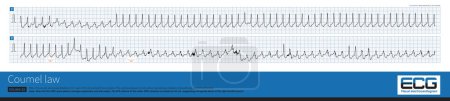 Photo for In atrioventricular reentrant tachycardia, sudden bundle branch block with a prolonged RR interval of more than 35 mm indicates that the bypass is on the side of the bundle branch block. - Royalty Free Image