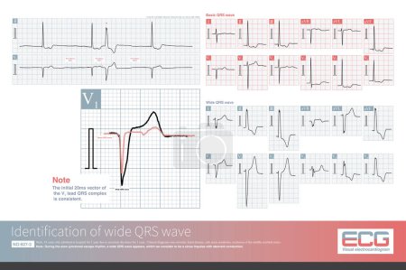 Photo for In lead V1, when the initial vector (20m) of the wide QRS wave and the basic QRS wave are exactly the same, it is highly indicated that the wide QRS wave is abberant conduction. - Royalty Free Image