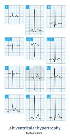 Téléchargez les photos : L "électrocardiogramme d" un patient atteint d "une hypertrophie ventriculaire gauche sans modification de la ST. - en image libre de droit