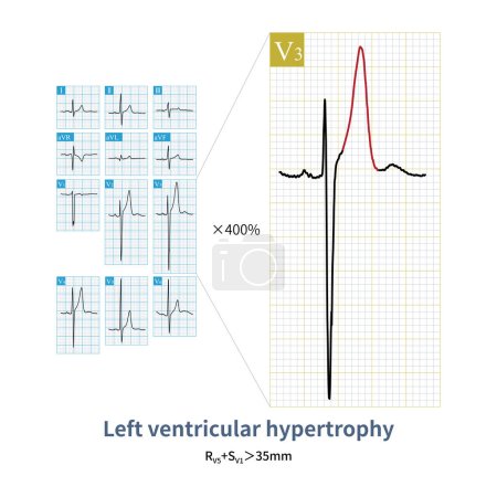 Téléchargez les photos : Lorsque la charge de volume ventriculaire gauche augmente, l'ECG montre non seulement des changements dans l'hypertrophie ventriculaire gauche, mais augmente également l'amplitude de l'onde T. - en image libre de droit