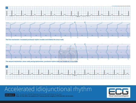 Photo for Male, 76 years old, clinically diagnosed with coronary heart disease. ECG showed that sinus rhythm and rapid junctional rhythm alternate, with the latter being the predominant. - Royalty Free Image